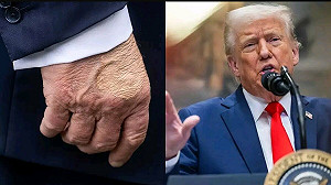 白宮證實川普「靜脈功能不全」 醫師呼籲:不只中老年人 「這族群」也要注意