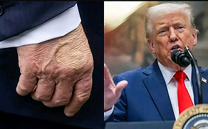 白宮證實川普「靜脈功能不全」 醫師呼籲：不只中老年人 「這族群」也要注意