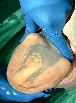 婦產名醫門診察覺異狀 急剖腹救雙胞胎脫險！陳志金感動轉發過程全曝光