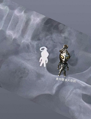 7歲男童誤吞「奧特曼吊飾」 X光照曝光網笑翻