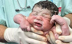 1%天選之人！巴西寶寶出生竟「手握T字避孕器」 網友：這局算你贏......