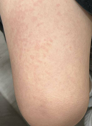 發燒、鮭魚色皮疹、關節痛齊發非感冒！醫示警：恐是史迪爾氏症候群 