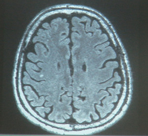 公布扁MRI  陳順勝：修護神經髓鞘可治癒