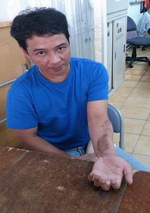 走不完的99哩異鄉路（一）差點沒了左手