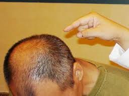 美科學家利用嬰兒包皮生髮技術突破