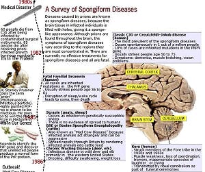 大腦海綿化 英每2千人中1人帶庫賈氏蛋白