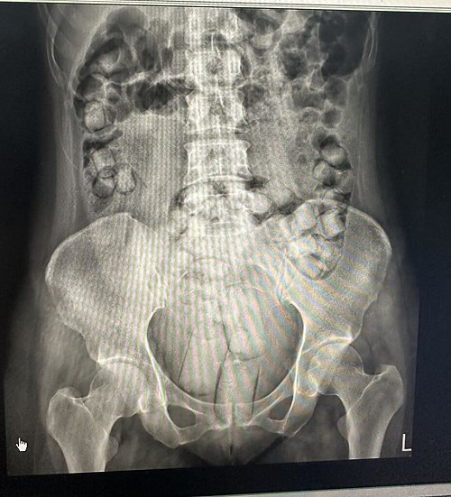 2泰女體內藏115顆海洛英來台　入境遭攔截送辦