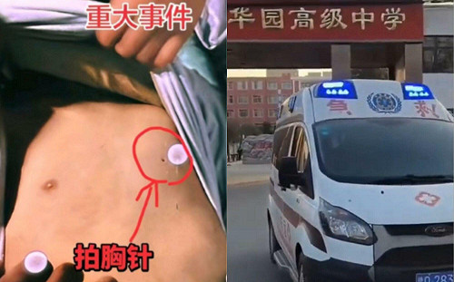 中國13歲生宿舍猝死校方竟偷運屍？左胸驚見「釘子大孔洞」真相引發網民怒火