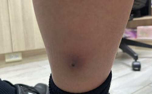12歲男童高燒喊腳痛！兒科醫見「腳上一紅腫」  驚喊：快送大醫院