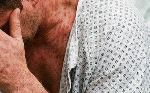 以為只是小感冒？高燒不退加「這些症狀」別輕忽！重症醫揭成人麻疹5大警訊