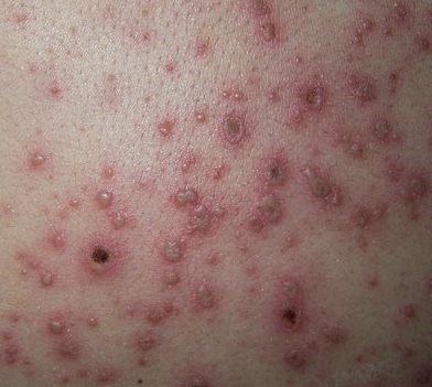 家長特別注意！水痘感染族群以國小比例最高