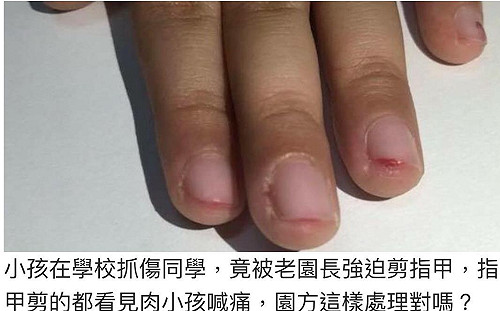 高市驚爆女童抓傷同學後疑遭虐  教局追查幼兒園長