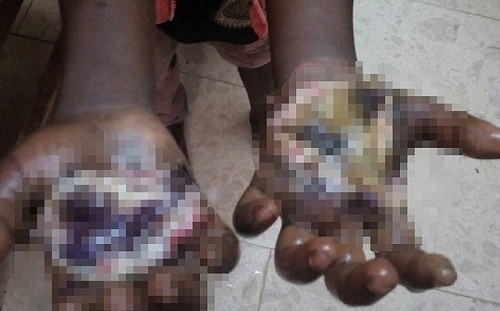 女童屢次偷竊遭父親懲罰 手被火烤到潰爛