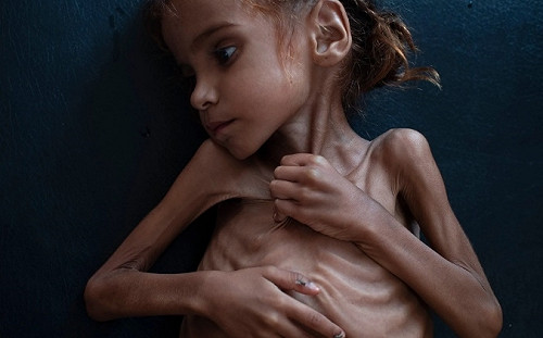 戰爭悲歌不停歇  皮包骨警示殘酷內戰