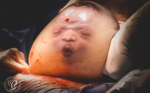 超罕見！羊水未破就出生　新生兒像「絲襪套頭」網路爆紅