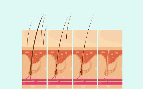 脂漏性毛囊炎掉髮　當心年節高熱量飲食復發