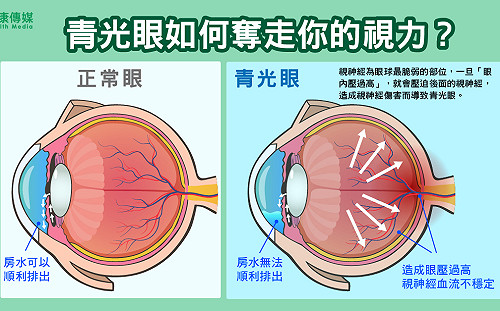 2020年全球罹患青光眼人數　恐破8千萬