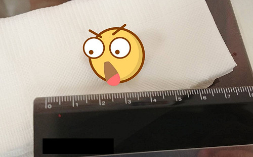 水喝不夠竟養出結石？「隕石級」結石險造成呼吸受阻