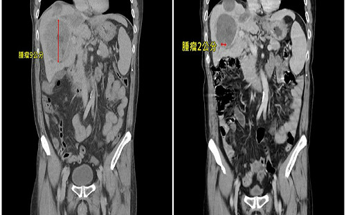 男患肝癌轉移「肺部佈滿數十顆腫瘤」　用對療法僅剩兩顆