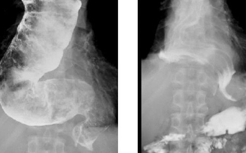 胃食道逆流、胸痛、體重狂降？小心是「食道遲緩不能症」