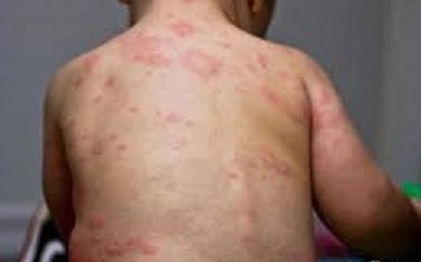 阿根廷爆麻疹疫情 3個月內病例劇增