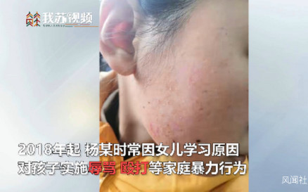 江蘇虎媽「望女成鳳」對女兒「鐵鏟燙臉」  遭法院撤銷監護人資格