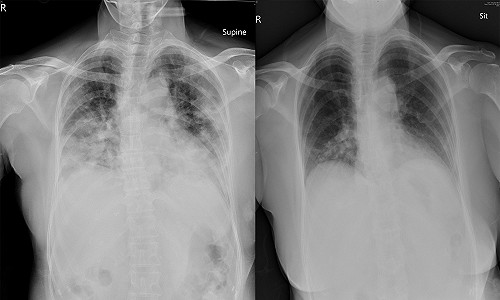 北病南送確診重症患者出院 捐款6萬為嘉基添購防疫設備