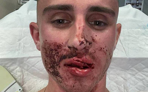 飛來重拳！愛爾蘭跆拳道國手返國遇襲  須接受面部修復手術