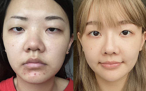 Youtuber「福爾思庭」整形前後大對比！粉絲驚：完全看不出來