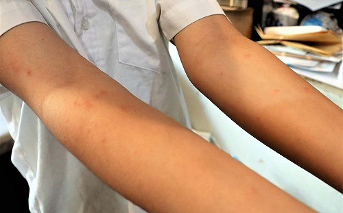 澎湖爆怪病！大批民眾皮膚奇癢紅腫就診 衛生局回應了