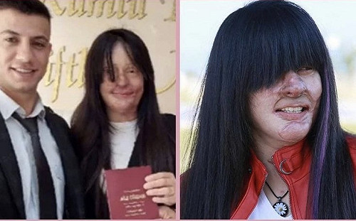 愛情真讓她「盲目」！ 女子遭控制狂男友潑酸毀容 不顧反對仍要嫁他