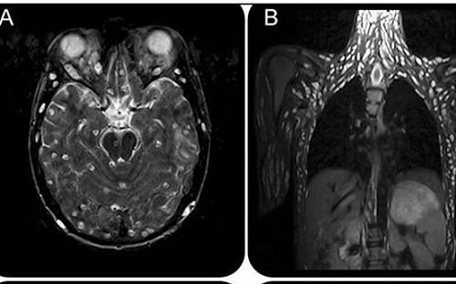 吃生豬肉抽蓄「感官扭曲」！男子就醫檢查驚見「全身長滿寄生蟲」