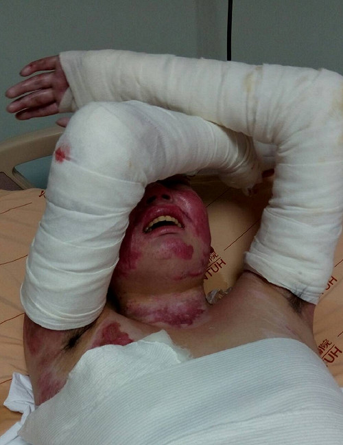 塵爆還在住院傷患家屬：爸媽會陪你走出醫院