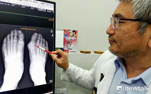 拇趾外翻主因為遺傳 醫師建議疼痛且夾角大於25度應考慮手術治療