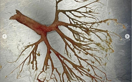 50歲男呼吸衰竭「咳出人蔘」 醫師Po出震撼照 網大驚：是被寄生嗎