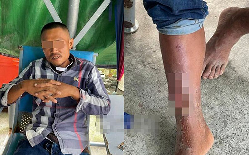 33歲台中男子淪柬埔寨豬仔遭｢割肉見骨｣丟包 流浪西港街頭如老30歲