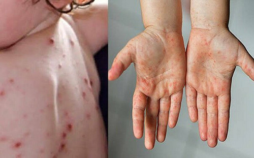 死亡率將近70%! 印度出現「番茄流感」超過80例 已58童亡