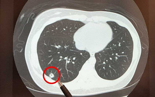 嚇壞14億人！ 打科興新冠疫苗後出現肺結節？中國緊急「闢謠」