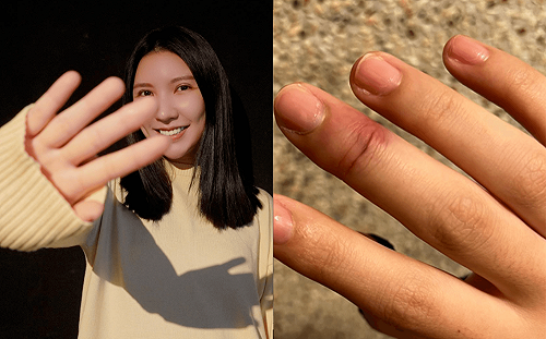 《全明星》田依甯骨折手指歪掉！傷勢畫面流出：穿褲子都難