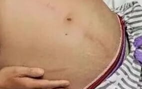 她肚子裏有「蟒蛇」? 女子患「這種病」 手術竟取出「1公尺巨蟒」