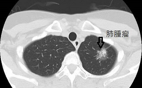 肺癌病友福音！健保擴大給付標靶藥「泰格莎」患者年省115萬