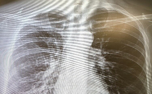 認識「會走路的肺炎」戴口罩、勤洗手  嚴防黴漿菌侵襲
