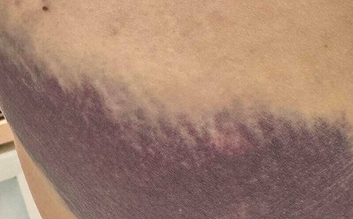 羅智強曬陳菁徽「臀部瘀青」稱鍾佳濱性騷擾 稍有不慎命都沒有