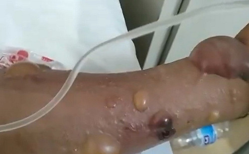 (影) 山東驚見炭疽病5人確診! 官方昨稱未傳人 養殖場出事後還到處賣肉