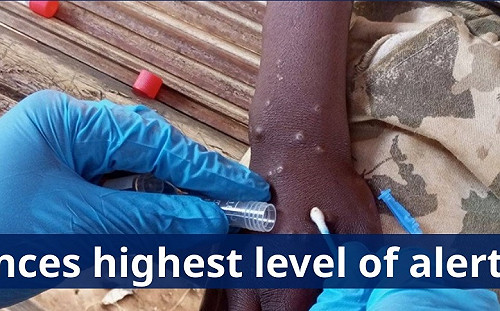 2年來第2次 猴痘再被宣布為全球公共衛生緊急事件