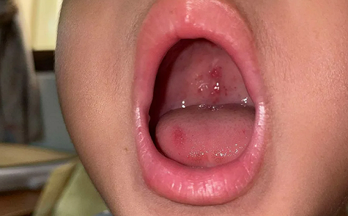 腸病毒校園大爆發！兒科醫曝脫水恐致命：5大警訊不可不知