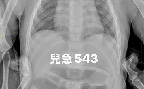 巴克球超危險！1歲童竟吞10顆釀腸穿孔 醫警告：初期無症狀難察覺