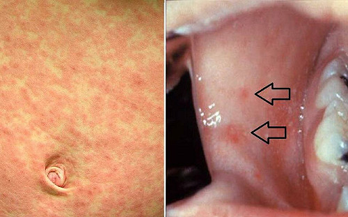 北市麻疹個案曾搭公車、板南線　衛生局籲健康監測
