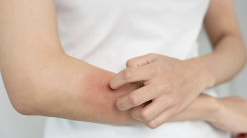 麻疹群聚擴大！三重男染疫　曾赴台北吃西堤「3天足跡一次看」