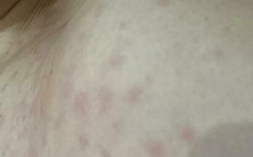 癢到懷疑人生？醫點名4種家中難發現的蟲　防治攻略一次看